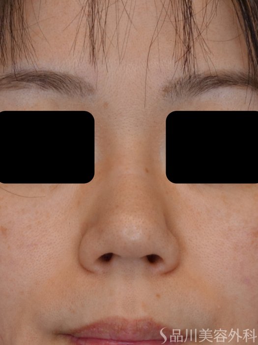 症例NO.74343のBEFORE写真