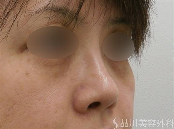 症例NO.25034のAFTER写真