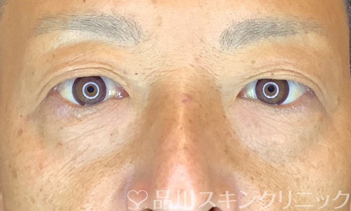 症例NO.74705のBEFORE写真