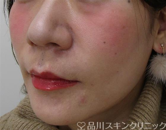 症例NO.45330のAFTER写真