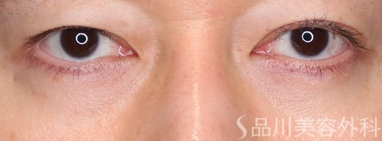 症例NO.73572のAFTER写真