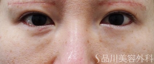 症例NO.70835のAFTER写真