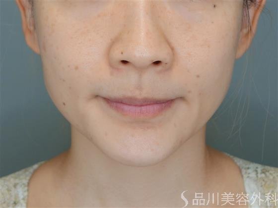 症例NO.52146のBEFORE写真