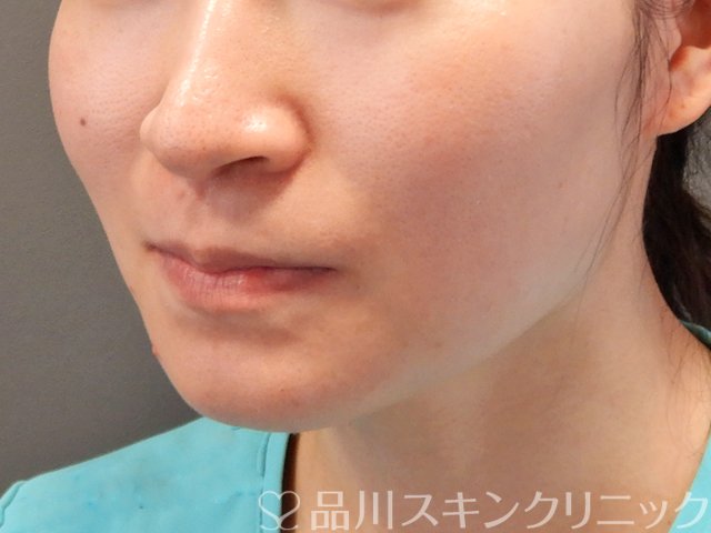 症例NO.70315のBEFORE写真
