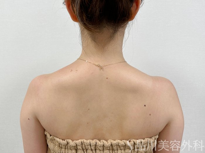 症例NO.73704のAFTER写真