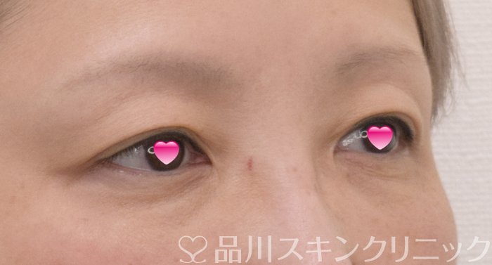 症例NO.74272のBEFORE写真