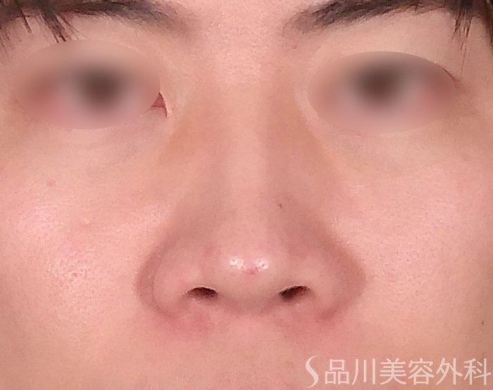 症例NO.69162のAFTER写真