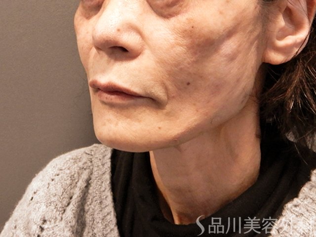 症例NO.67883のAFTER写真