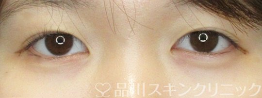 症例NO.69862のAFTER写真