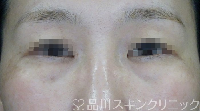 症例NO.62121のBEFORE写真