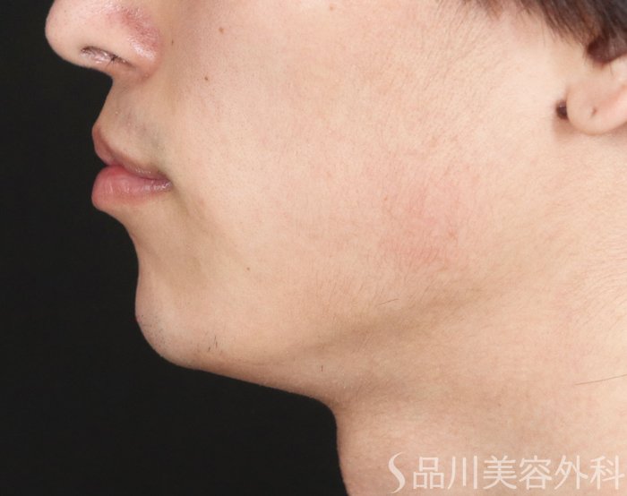 症例NO.73766のAFTER写真