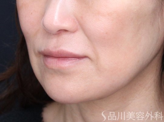 症例NO.73386のAFTER写真