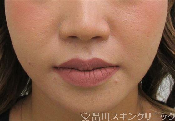 症例NO.39180のBEFORE写真