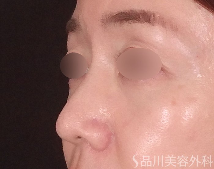 症例NO.70440のBEFORE写真