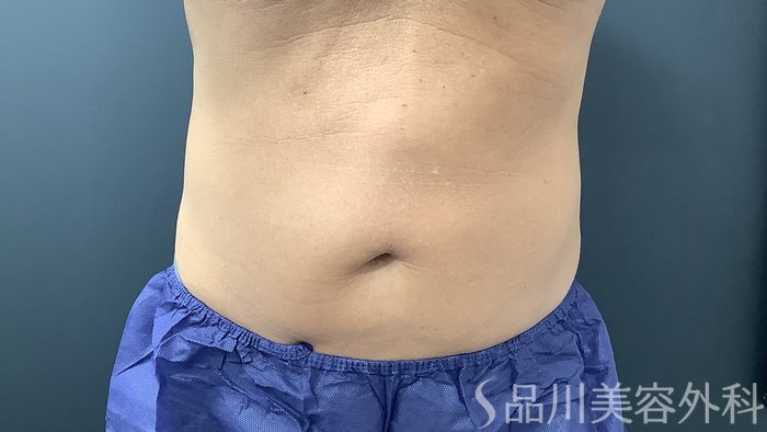症例NO.75369のAFTER写真