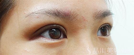 症例NO.25020のAFTER写真