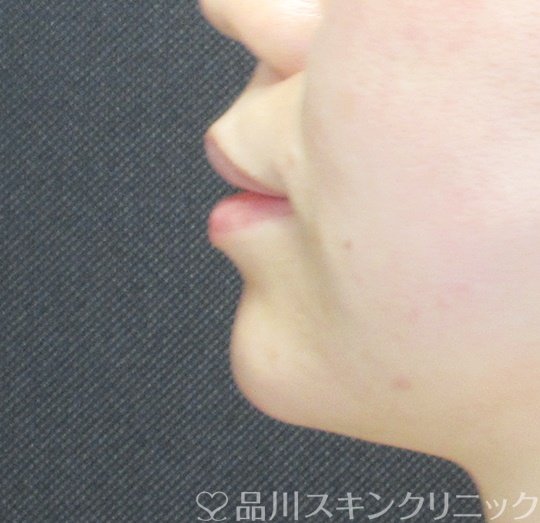症例NO.70048のAFTER写真