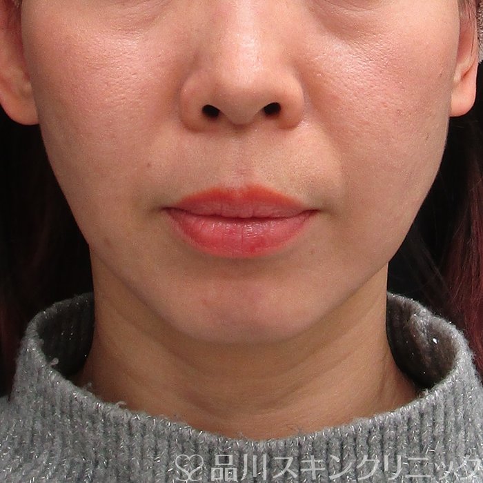 症例NO.70307のBEFORE写真