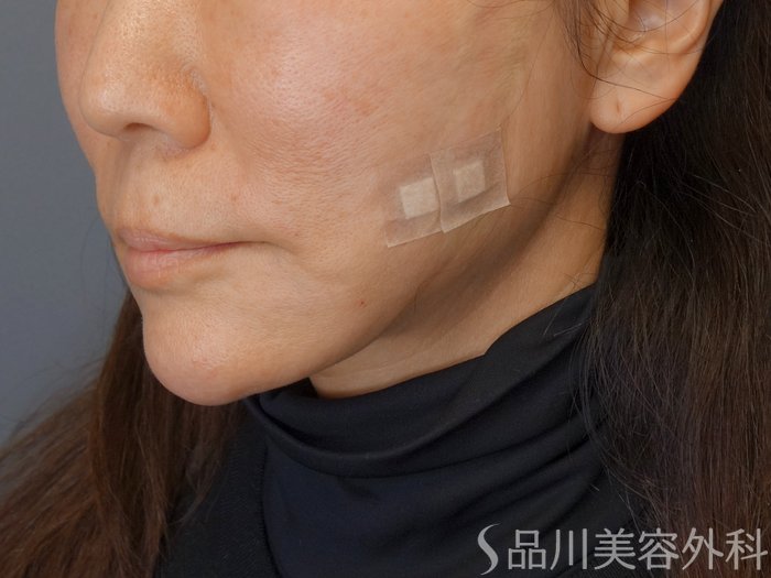 症例NO.72893のAFTER写真