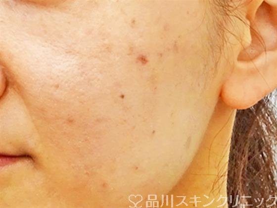 症例NO.51614のAFTER写真
