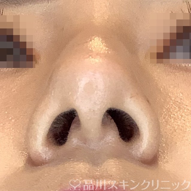 症例NO.69865のAFTER写真