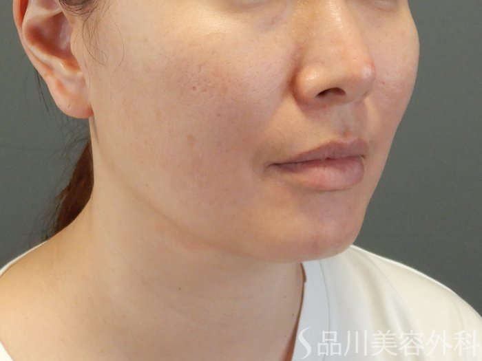 症例NO.65379のBEFORE写真