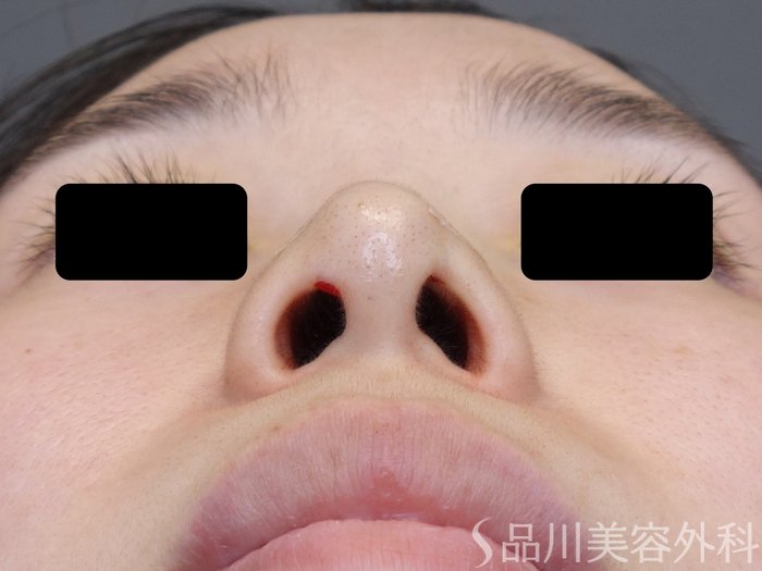 症例NO.74962のAFTER写真