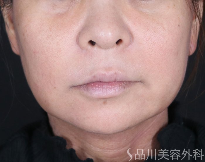 症例NO.73599のBEFORE写真