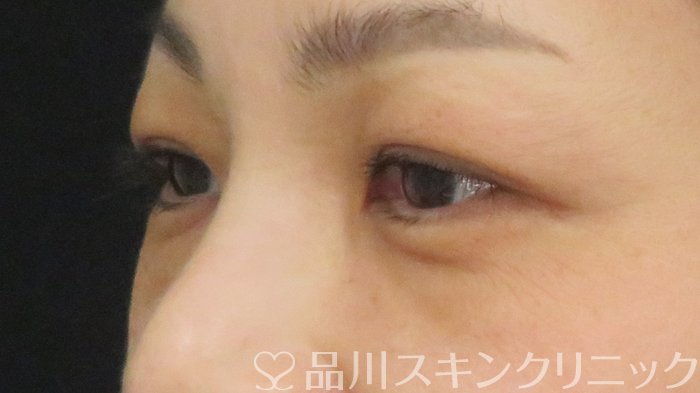 症例NO.72909のBEFORE写真