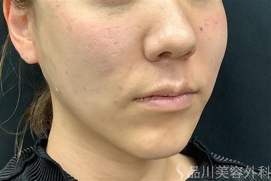 症例NO.61701のAFTER写真