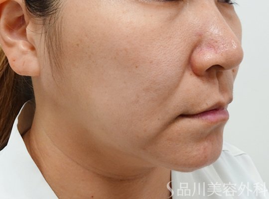 症例NO.72846のBEFORE写真