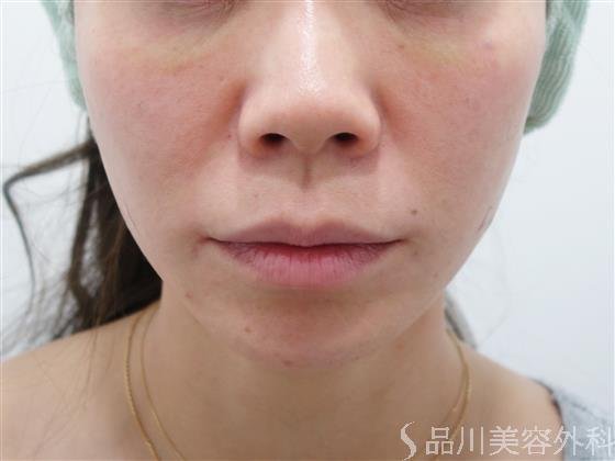 症例NO.41609のAFTER写真