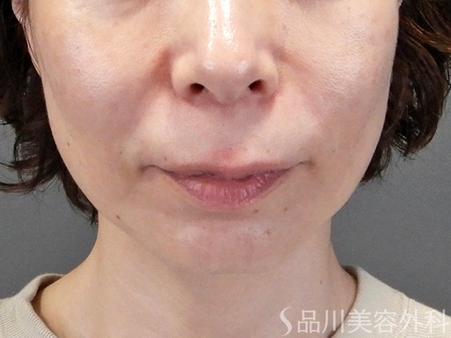 症例NO.69682のAFTER写真