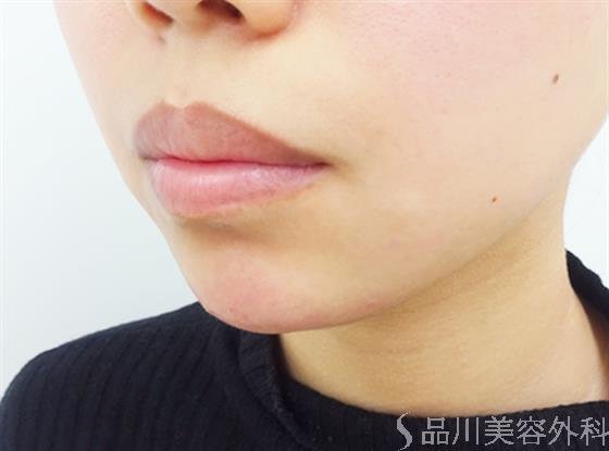 症例NO.40864のAFTER写真