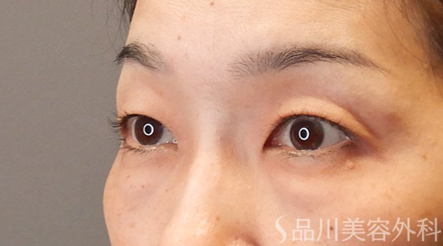 症例NO.75014のBEFORE写真