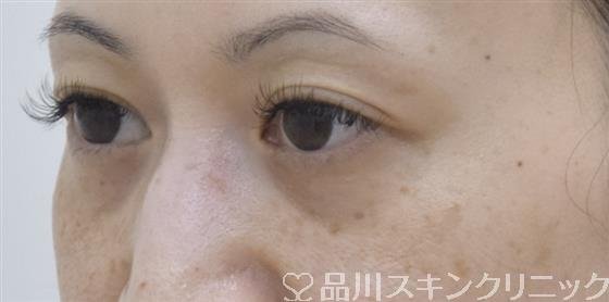 症例NO.53280のAFTER写真