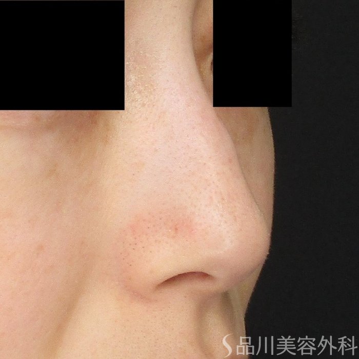 症例NO.70930のBEFORE写真