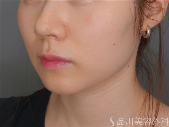 症例NO.52937のAFTER写真