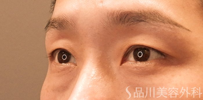 症例NO.69805のBEFORE写真