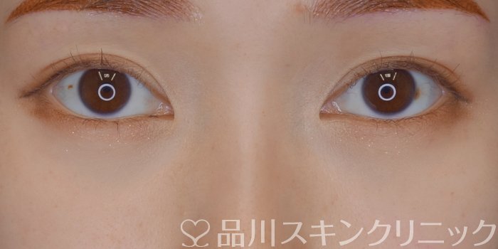 症例NO.72481のAFTER写真