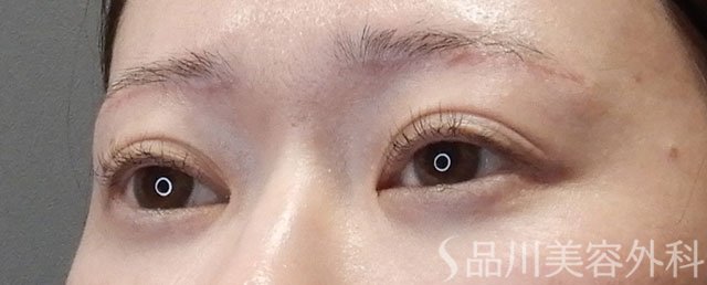 症例NO.74127のAFTER写真