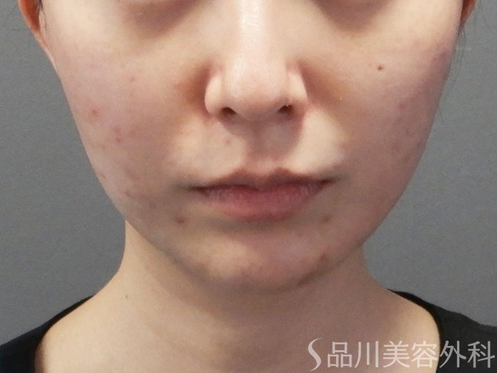 症例NO.72591のAFTER写真