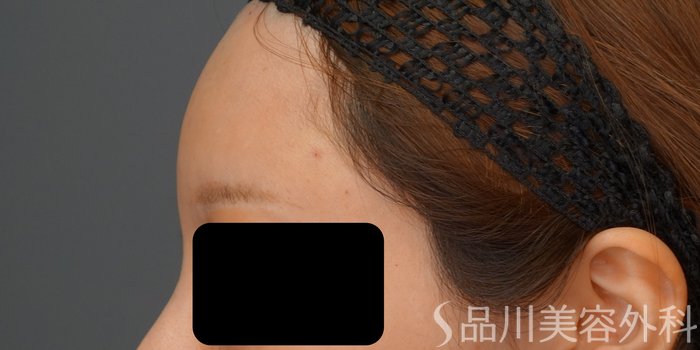 症例NO.73259のAFTER写真