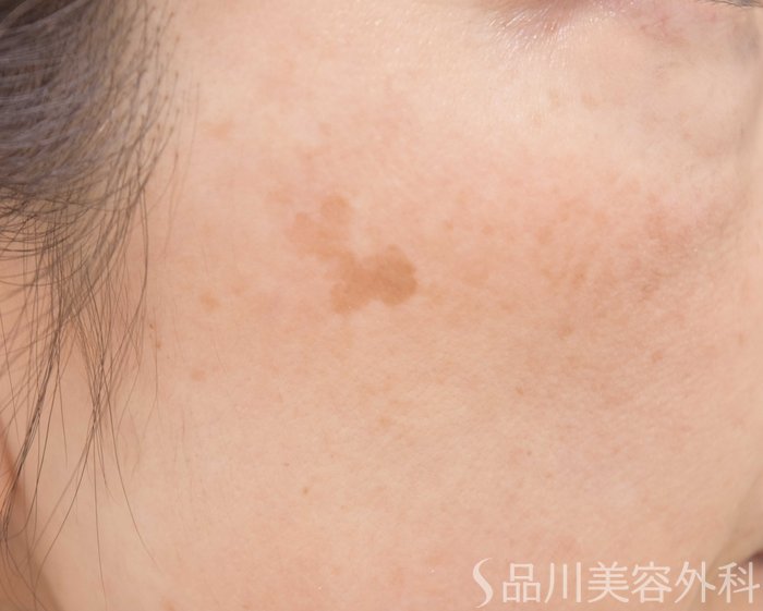 症例NO.66045のBEFORE写真