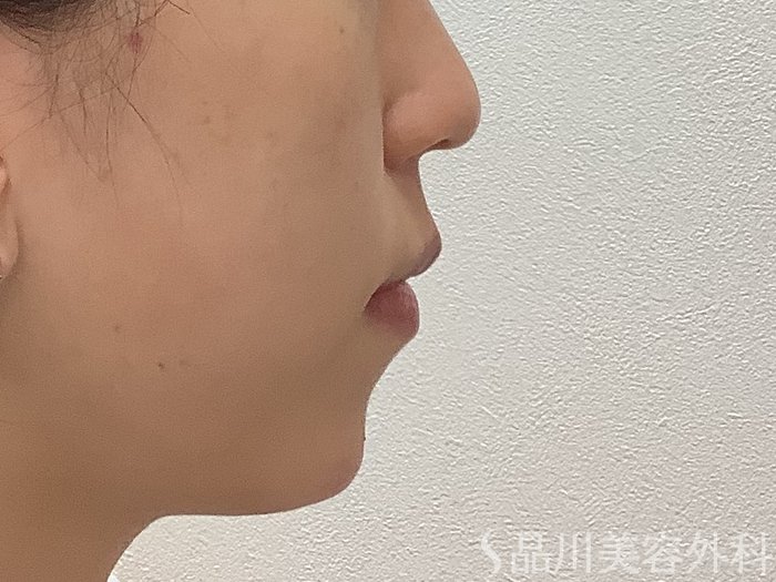 症例NO.67892のAFTER写真