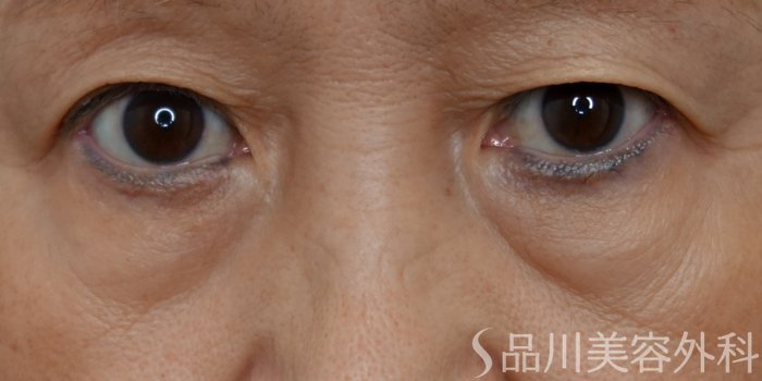 症例NO.69320のBEFORE写真