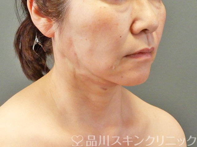 症例NO.67753のAFTER写真