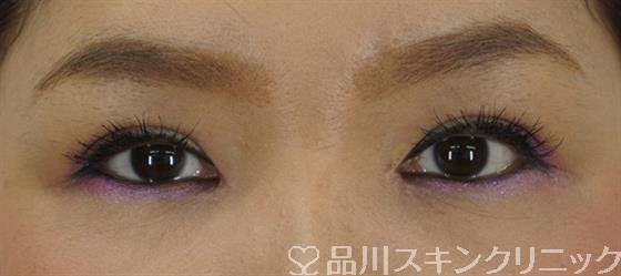 症例NO.42848のAFTER写真