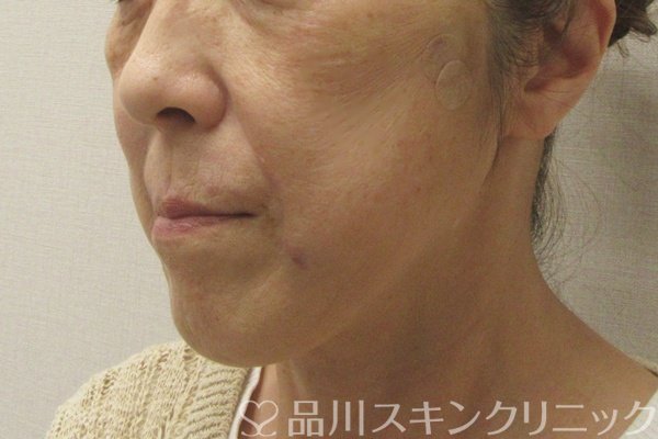 症例NO.75072のAFTER写真