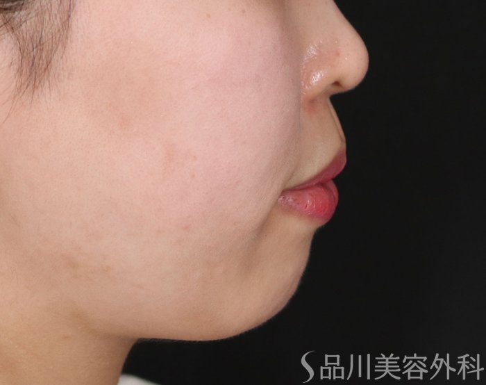 症例NO.70749のBEFORE写真